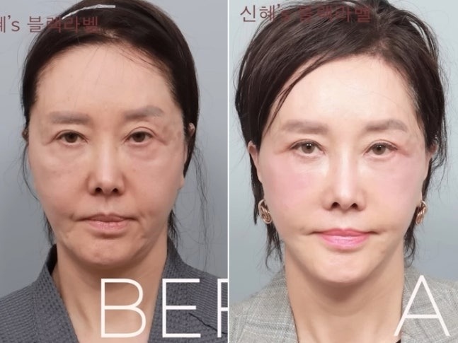 限界ギリギリまで整形、60代とは思えないビジュアルに！韓国ベテラン女優の潔すぎる告白が話題