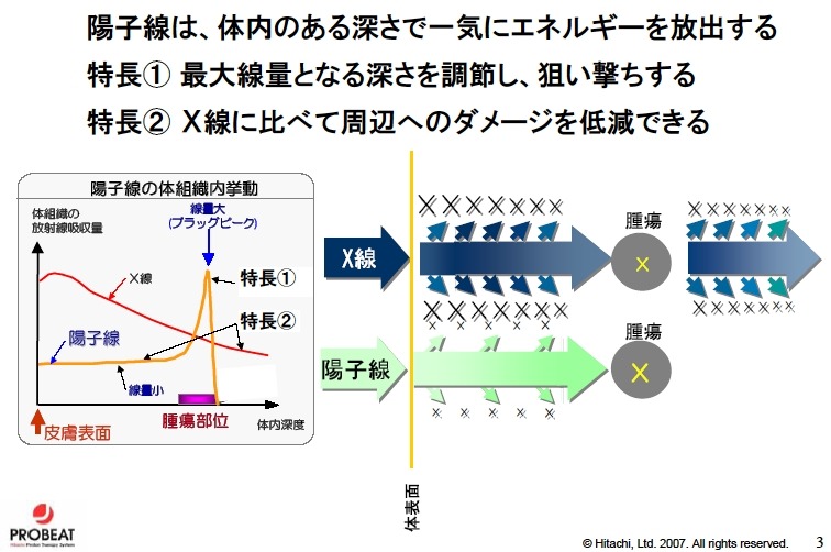 X線治療と違い、患部の深さによってエネルギーを調整できる