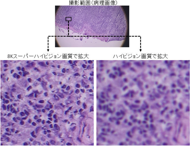 病理画像の拡大図。左が8Kスーパーハイビジョン画質、右は従来のハイビジョン画質。8K技術を活用して高画質な映像を遠隔地に伝えることで、従来の遠隔医療では対応が困難であった細かな病変の発見等が期待される（画像はプレスリリースより）