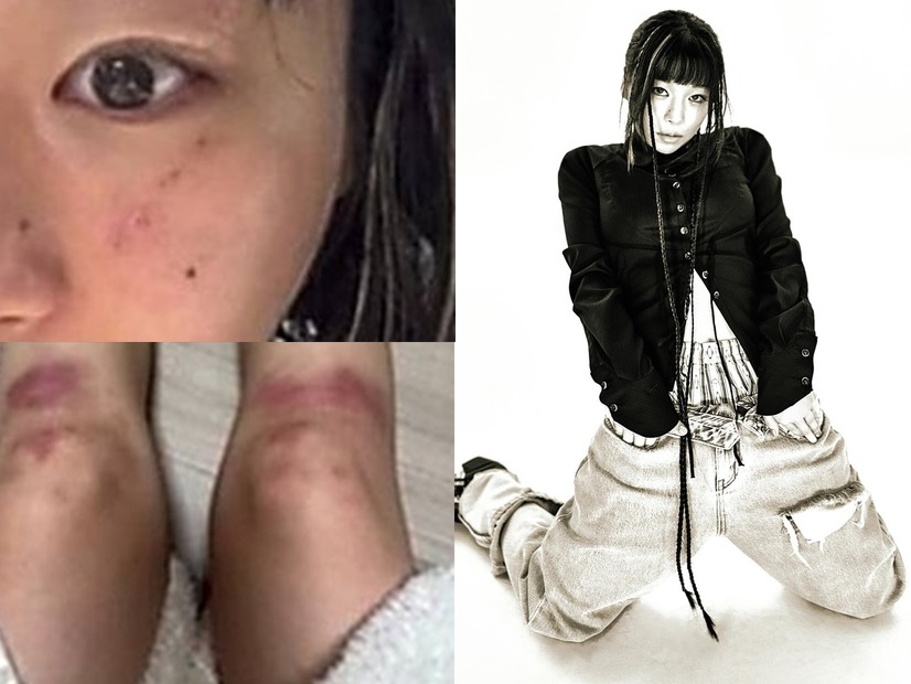 ボコボコに殴られたような写真はなんだったのか…元恋人のDV疑惑を提起した韓国女性ラッパー、立場を翻す