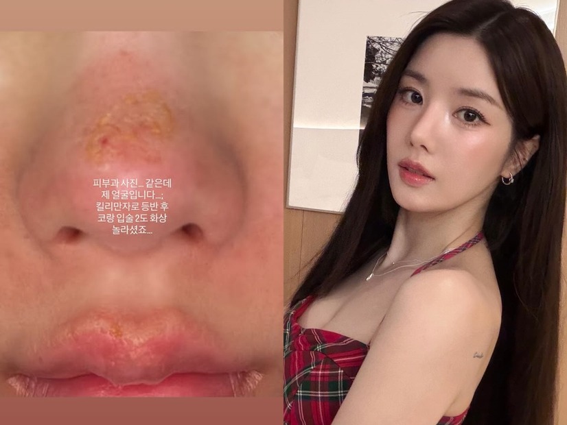 顔がズルむけ…「Ⅱ度のやけど」を負った“びしょ濡れフェスの女神”クォン・ウンビ、衝撃の近況を公開