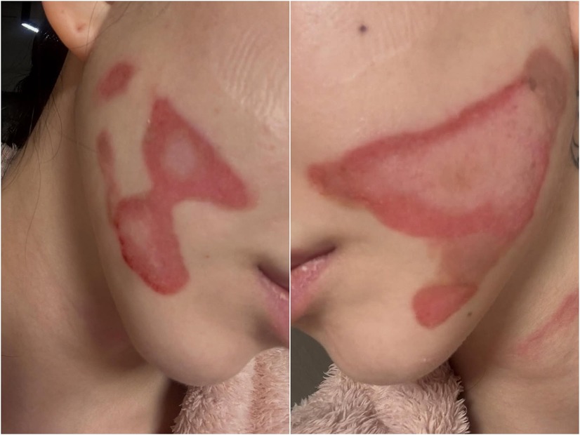 両頬に痛々しいやけど痕…元K-POPアイドルが医療事故被害を主張、訴訟へ「皮膚が裂けるような痛み」