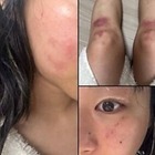 顔は腫れ脚には痣…韓国女性ラッパーがDV被害を暴露、お相手は元恋人の音楽P　食い違う主張 画像