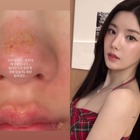 顔がズルむけ…「Ⅱ度のやけど」を負った“びしょ濡れフェスの女神”クォン・ウンビ、衝撃の近況を公開 画像