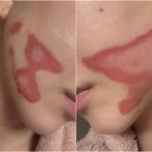 両頬に痛々しいやけど痕…元K-POPアイドルが医療事故被害を主張、訴訟へ「皮膚が裂けるような痛み」 画像