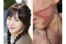 いまだに癒えぬ頬の大きなやけど痕…元K-POPアイドル、治療費稼ぐため美容皮膚科に転職 画像