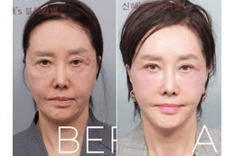 限界ギリギリまで整形、60代とは思えないビジュアルに！韓国ベテラン女優の潔すぎる告白が話題 画像