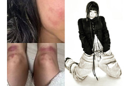 ボコボコに殴られた写真を投稿…交際していた男からのDV被害を主張した韓国女性ラッパー、所属事務所も支援へ 画像
