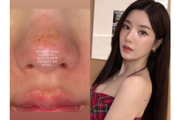 顔がズルむけ…「Ⅱ度のやけど」を負った“びしょ濡れフェスの女神”クォン・ウンビ、衝撃の近況を公開 画像