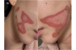 両頬に痛々しいやけど痕…元K-POPアイドルが医療事故被害を主張、訴訟へ「皮膚が裂けるような痛み」 画像