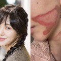 いまだに癒えぬ頬の大きなやけど痕…元K-POPアイドル、治療費稼ぐため美容皮膚科に転職 画像