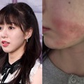 顔に残る“やけどの跡”…美容施術で医療事故被害の元K-POPアイドル、現状を公開「とても不安」 画像