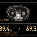 森永氏のダイエット前の腹部MRI