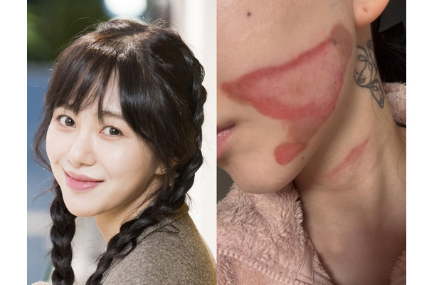 いまだに癒えぬ頬の大きなやけど痕…元K-POPアイドル、治療費稼ぐため美容皮膚科に転職