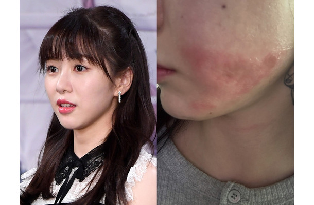 顔に残る“やけどの跡”…美容施術で医療事故被害の元K-POPアイドル、現状を公開「とても不安」