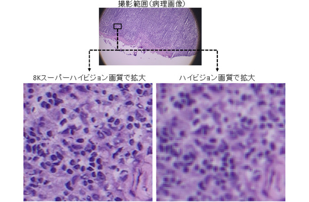 病理画像の拡大図。左が8Kスーパーハイビジョン画質、右は従来のハイビジョン画質。8K技術を活用して高画質な映像を遠隔地に伝えることで、従来の遠隔医療では対応が困難であった細かな病変の発見等が期待される（画像はプレスリリースより）