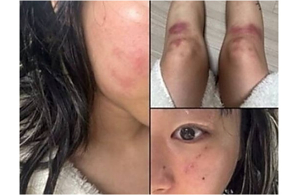 顔は腫れ脚には痣…韓国女性ラッパーがDV被害を暴露、お相手は元恋人の音楽P　食い違う主張