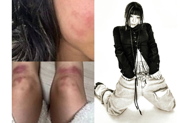 ボコボコに殴られた写真を投稿…交際していた男からのDV被害を主張した韓国女性ラッパー、所属事務所も支援へ