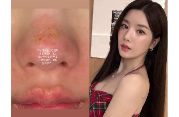 顔がズルむけ…「Ⅱ度のやけど」を負った“びしょ濡れフェスの女神”クォン・ウンビ、衝撃の近況を公開