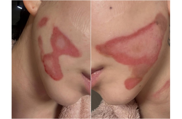 両頬に痛々しいやけど痕…元K-POPアイドルが医療事故被害を主張、訴訟へ「皮膚が裂けるような痛み」