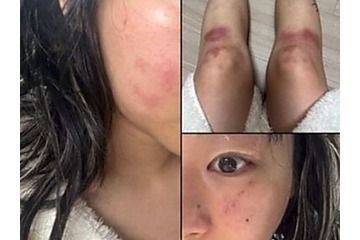 顔は腫れ脚には痣…韓国女性ラッパーがDV被害を暴露、お相手は元恋人の音楽P　食い違う主張 画像