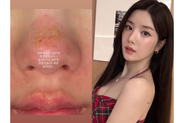 顔がズルむけ…「Ⅱ度のやけど」を負った“びしょ濡れフェスの女神”クォン・ウンビ、衝撃の近況を公開 画像