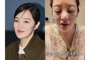 別人級に腫れた顔…『キム秘書』女優ファン・ボラ（42）、体外受精の副作用で健康悪化「体はボロボロ」 画像