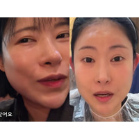 豊胸・整形に総額“1億5000万ウォン”投入の韓国芸人　今度は“耳”を改造「めちゃくちゃ不思議！」 画像