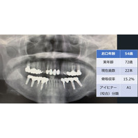 歯科エックス線画像を用いた「お口年齢AI」の開発について