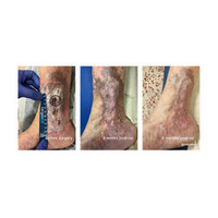 VERIGRAFT、CVIに対する初の根治的治療法となる可能性がある治療法を極めて重要な第II/III相試験に進める